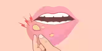 Ilustação de uma boca com afta