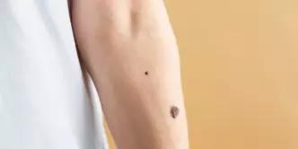 Close up de um braço com verrugas de diferentes tamanhos